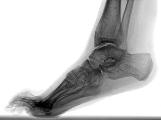 علت اکواینوس یا کوتاهی تاندون پشت ساق و راه رفتن روی پنجه پا چیست؟