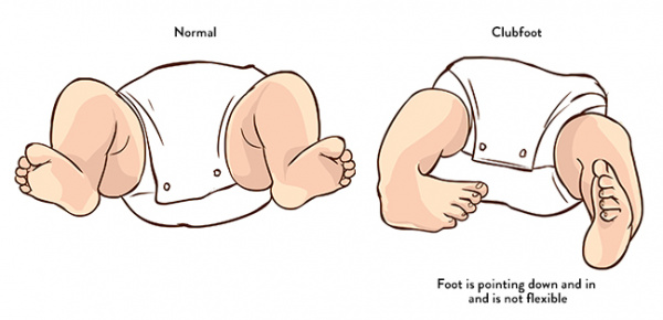 کلاب فوت ( club foot ) چیست؟ درمان کلاب فوت با ماساژ